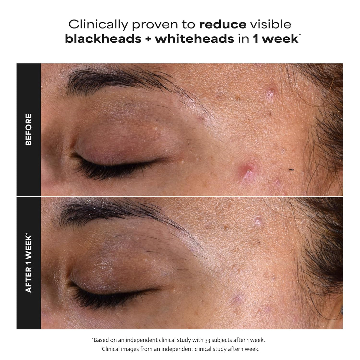 Paula's Choice SKIN PERFECTING 2% BHA Liquid Leave-On Exfoliant